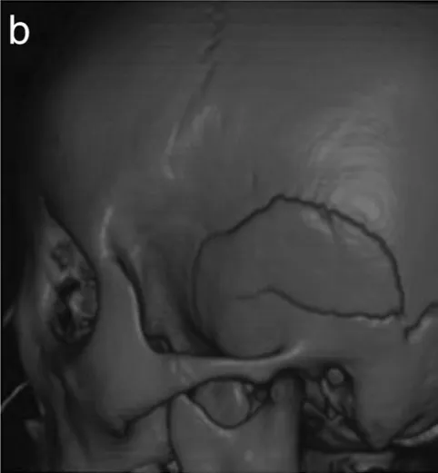 图b：3D骨CT显示多发性颅骨骨折