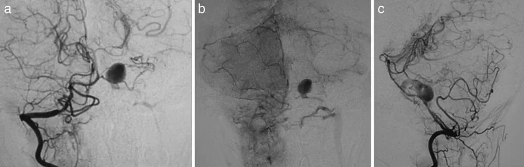 图a，b，c为第7天的右椎动脉造影。动脉瘤位于左AICA的近端。