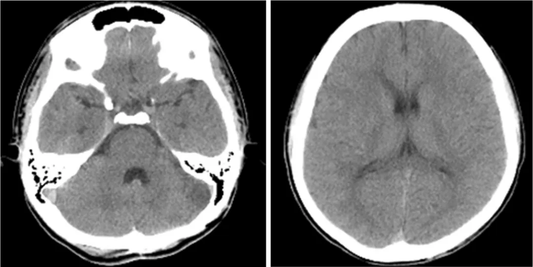 术后CT，无明显缺血性病变或脑积水