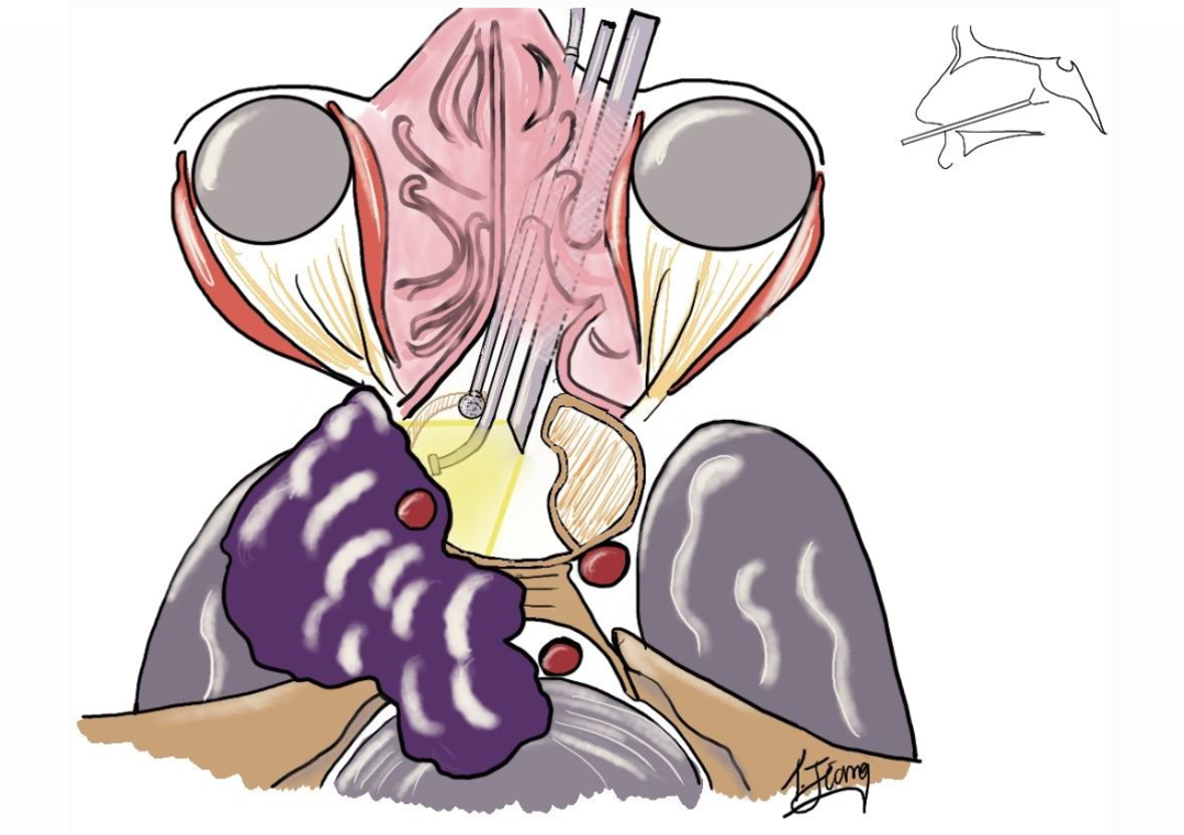 INC福洛里希教授术中操作步骤图解