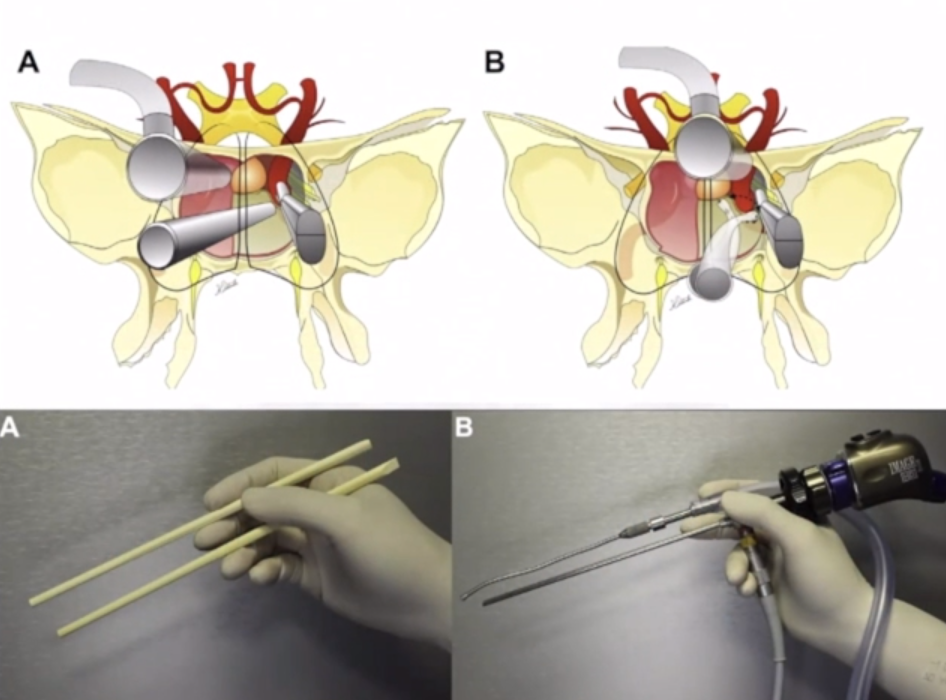 福洛里希教授-筷子手法