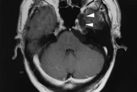 轴位T1加权图像显示稍高信号病灶伴占位效应；箭头指示Meckel腔内的肿瘤。