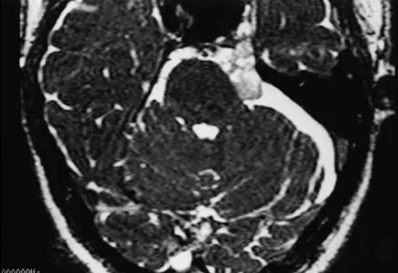 轴位CISS图像显示稍低信号病灶延伸至Meckel腔。