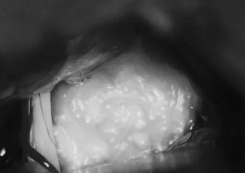 手术显微镜下观察CPA内"珍珠样"肿瘤位于前庭蜗神经上方，覆盖三叉神经。