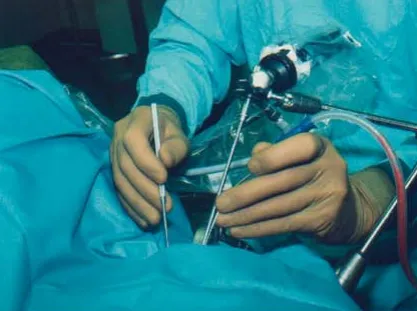 内镜辅助下双手操作（内镜由自固定装置固定）。