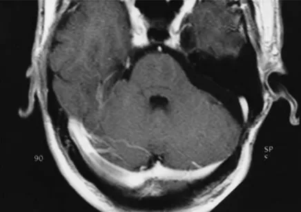 术后21个月轴位T1加权图像显示病灶完全切除，占位效应消失。