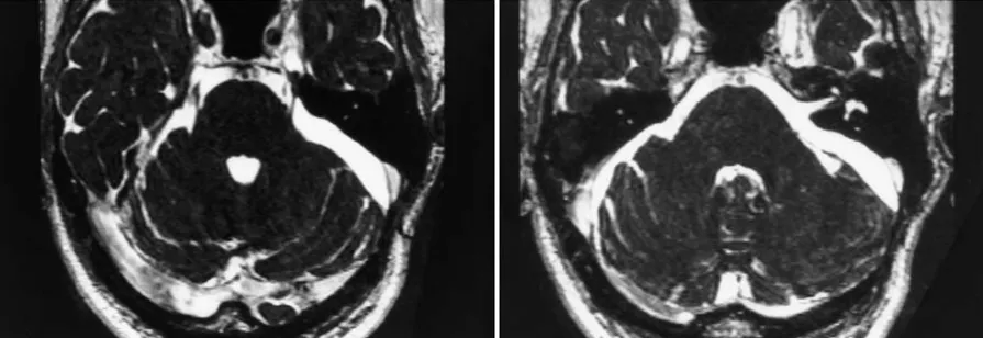 术后21个月轴位CISS图像显示无肿瘤残留或复发。