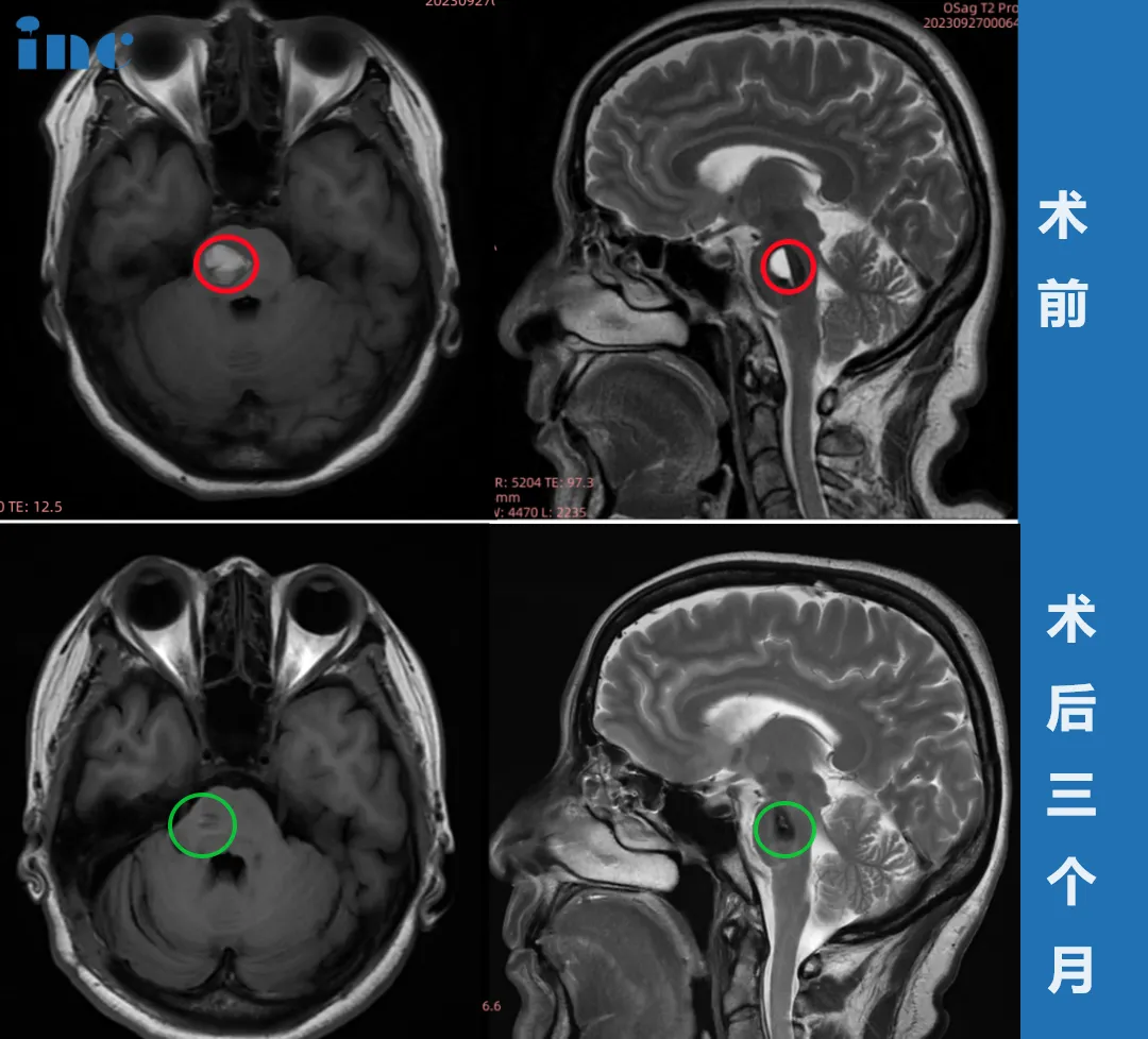 术后3个月影像对比