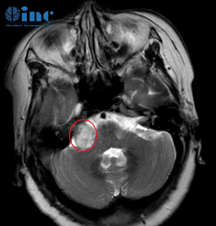70岁奶奶的“老年病”竟是3cm听神经瘤