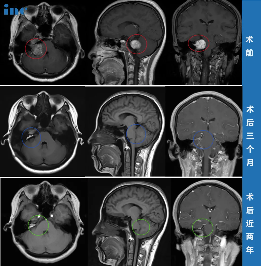 病例3：耳闷2年查不出，站立不稳时才发现3.5cm巨大肿瘤