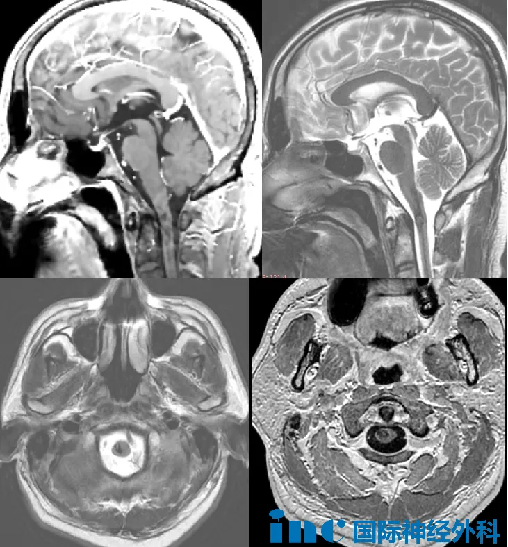 脊髓海绵状血管瘤影像