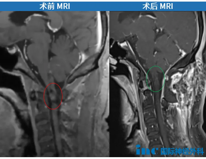 脊髓海绵状血管瘤MRI