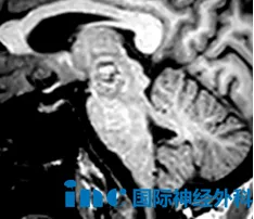 59岁脑干海绵状血管瘤