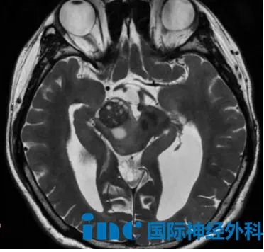 22岁神经纤维瘤病Ⅰ型
