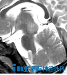 9个月男宝脑干胶质瘤