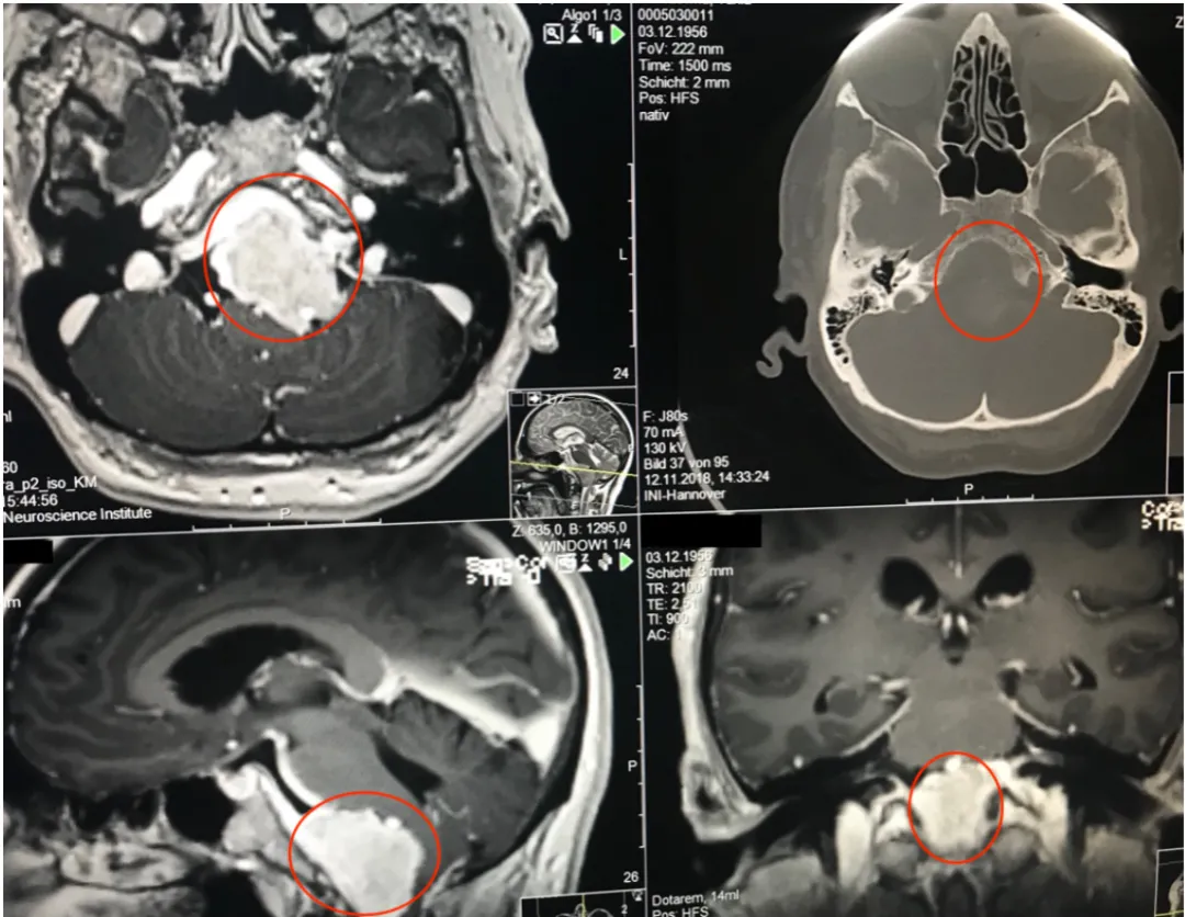 巨大岩斜区脑膜瘤术前