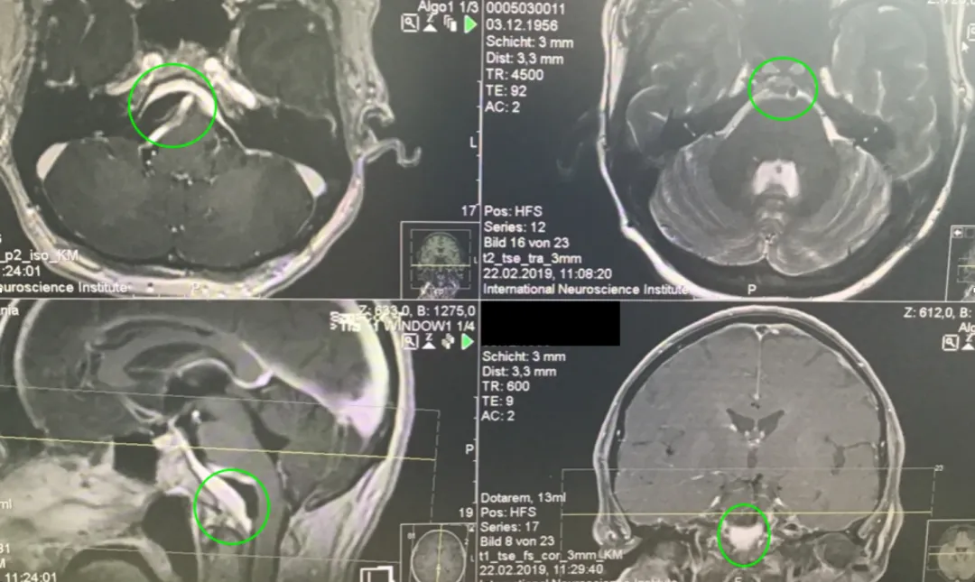 巨大岩斜区脑膜瘤术后