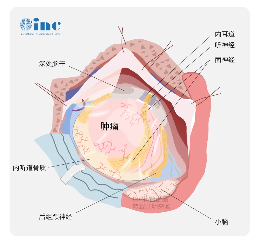如图所示：听神经和面神经相距很近