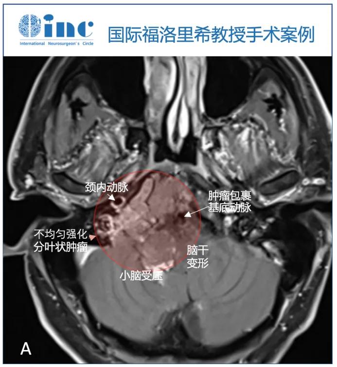 术前MRI显示轴内-轴外肿瘤，累及斜坡和颅颈交界处，压迫脑干致脑干移位，为不均匀增强（图A）。