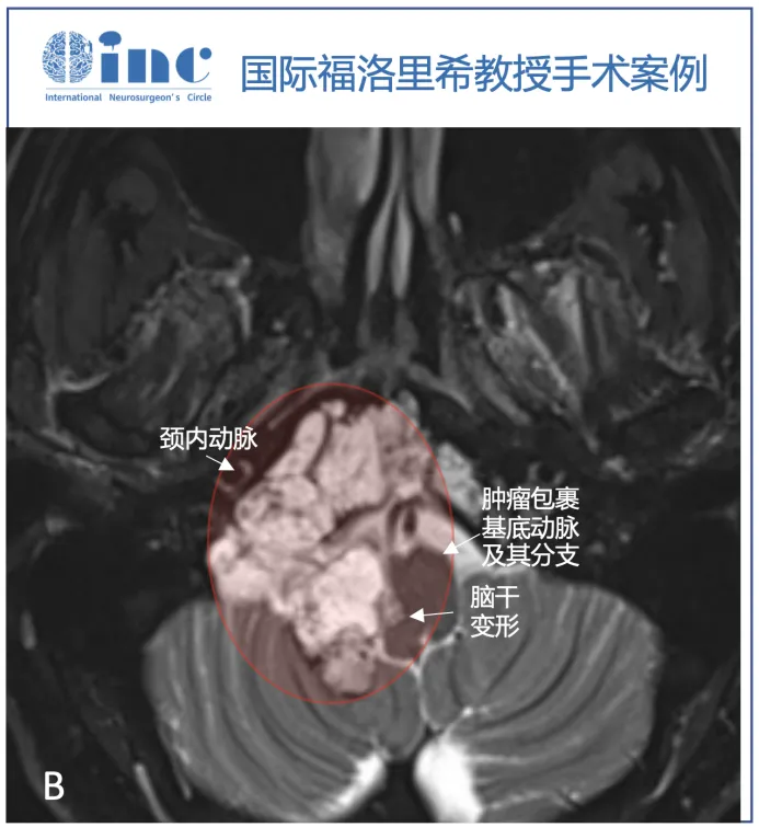 T2序列（B、C）上的多小叶形态和病变的生长模式，考虑脊索瘤。右侧枕髁被肿瘤完全破坏（C）。