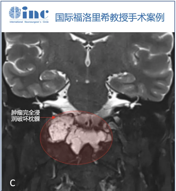 T2序列（B、C）上的多小叶形态和病变的生长模式，考虑脊索瘤。右侧枕髁被肿瘤完全破坏（C）。