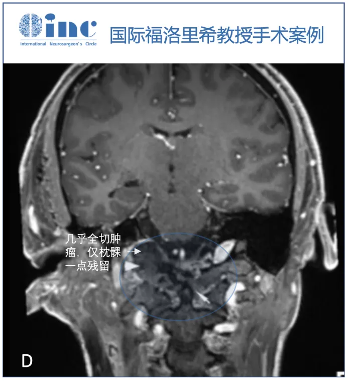 D：术后MRI显示齿状突外侧有一小块残留肿瘤(白色箭头)。自体脂肪用于清除死区(箭头)。