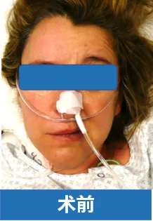 海绵状血管瘤患者