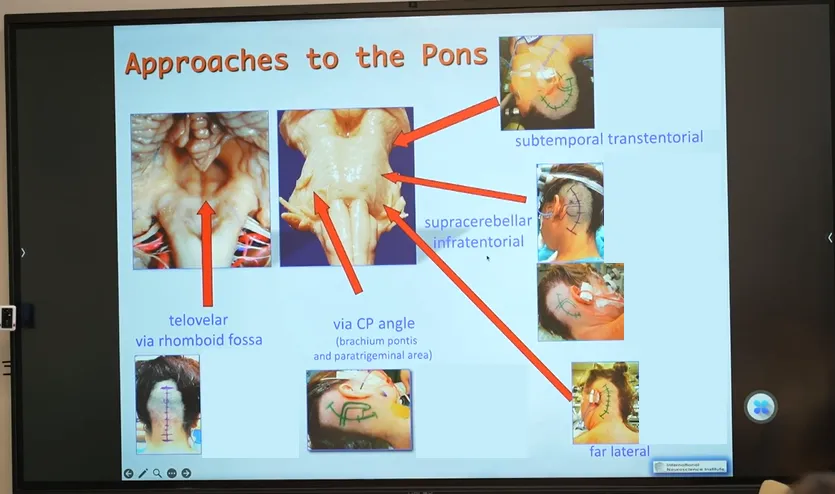 脑干海绵状血管瘤