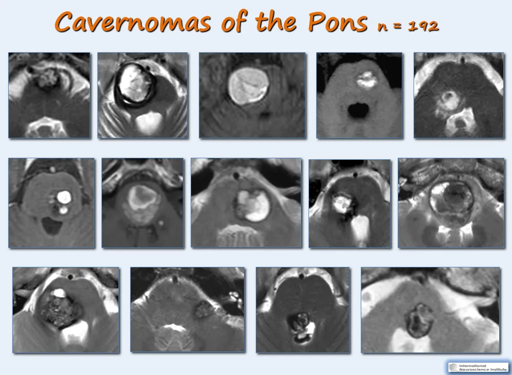 桥脑海绵状血管瘤案例