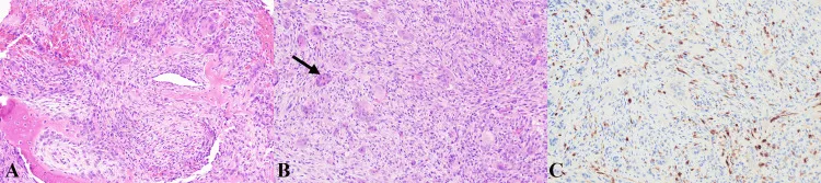 图2.肿块的组织病理学切片