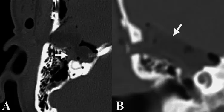 图3.术后影像学显示肿瘤切除情况