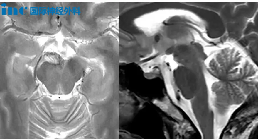右侧桥前池占位少量出血