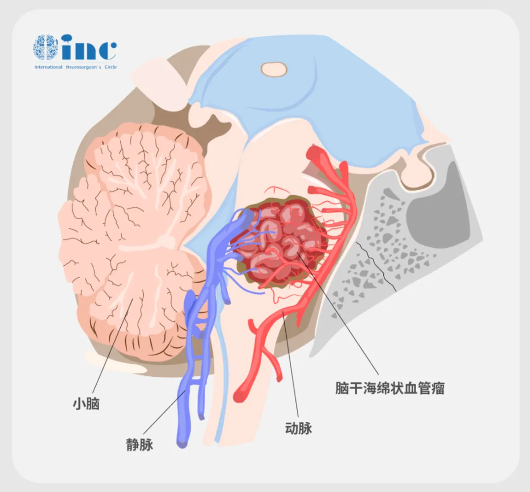 脑海绵状血管瘤