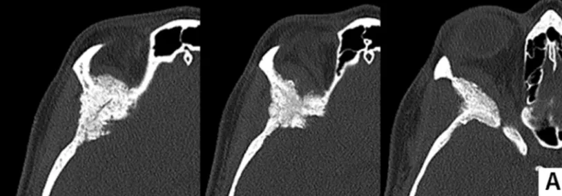 术前计算机断层扫描图像(骨窗)显示由蝶眶脑膜瘤引起的增生,涉及蝶骨大翼、蝶骨小翼、前床突以及眼眶上壁以及颞骨鳞部。