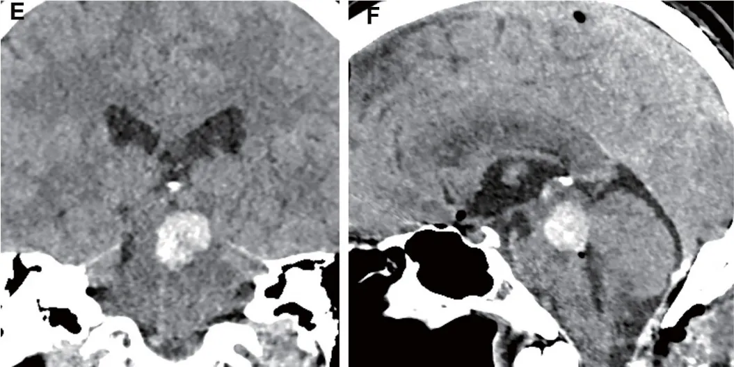 术后早期切除腔内的占位性血肿