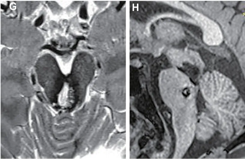 术后5个月轴位、矢状位磁共振成像，证实中脑海绵状畸形（MCM）完全切除。