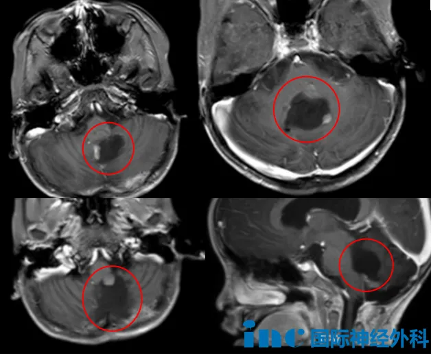 后颅窝室管膜瘤