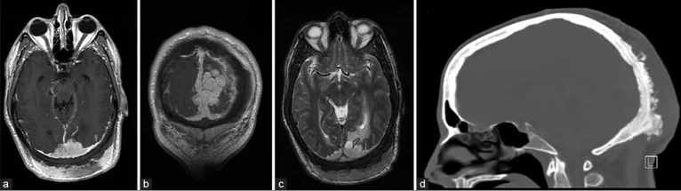 图1.轴位（a）与冠状位（b）增强T1加权MRI显示肿瘤包绕上矢状窦后部并延伸至窦汇