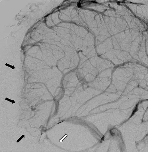 图2.左侧颈内动脉注射后脑血管造影侧位观