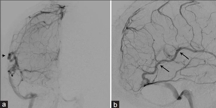 图3.右侧颈内动脉注射静脉期脑血管造影前后位（a）与侧位（b）观