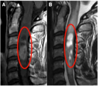 脊髓髓内室管膜瘤影像