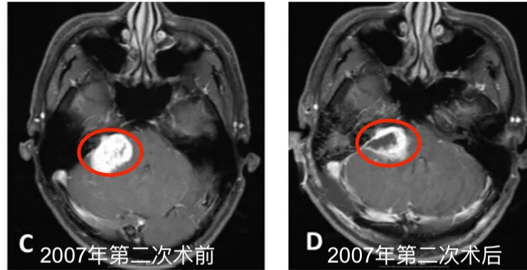 2007年5月第二次术前MR图像；D.术后1个月图像。