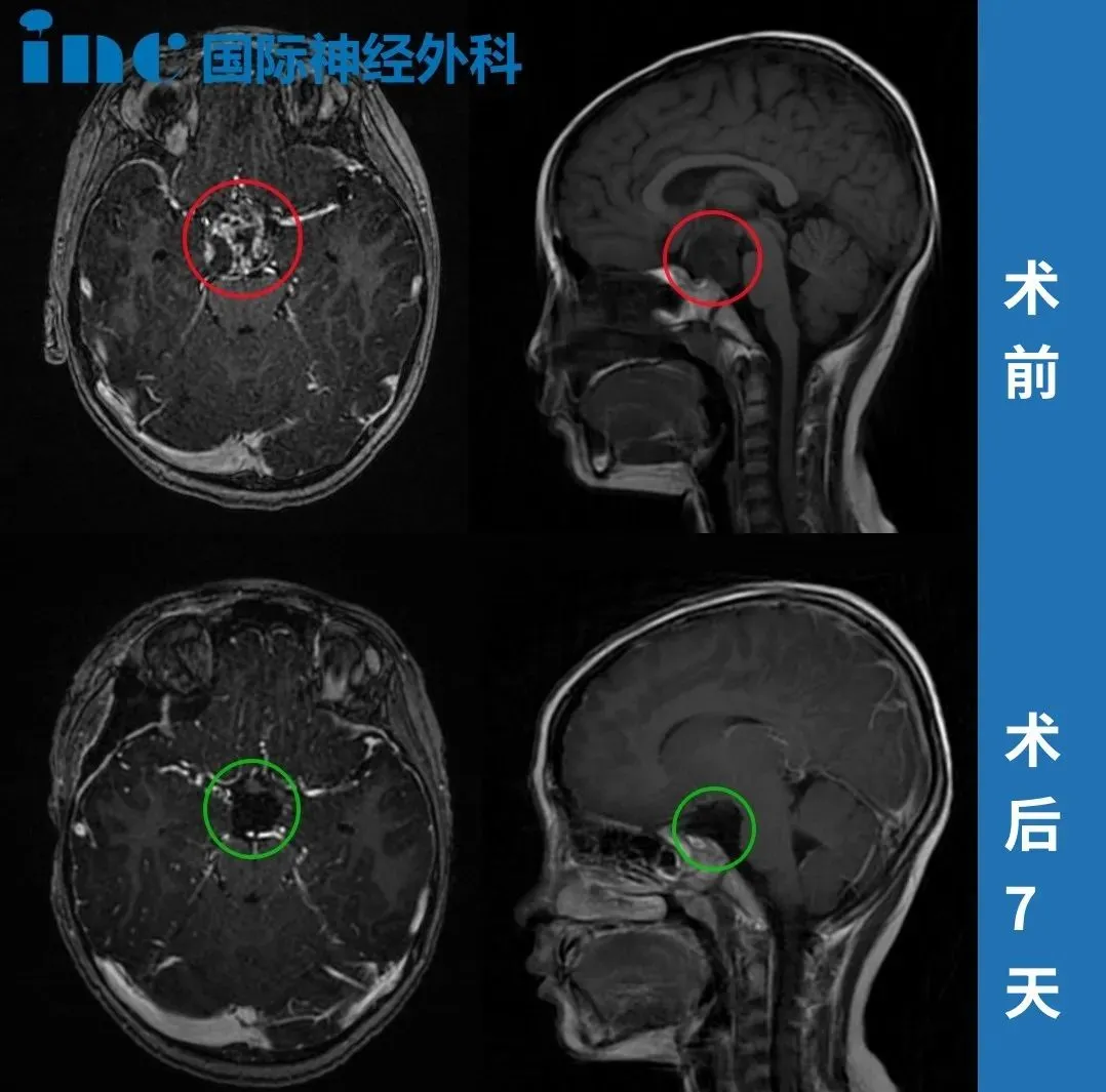 7岁男孩颅咽管瘤术后竟无需进ICU