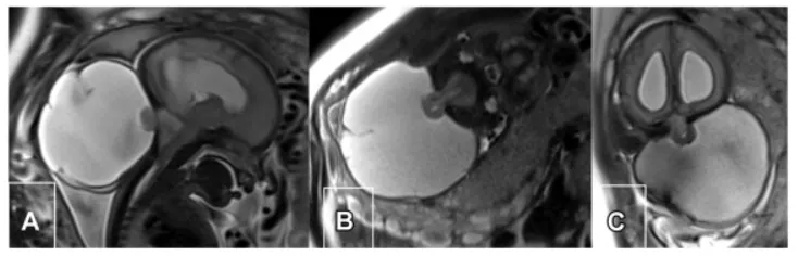 图1.宫内胎儿MRI。T2加权矢状位（A）、冠状位（B）和轴位（C）扫描显示巨大枕部脑膨出，伴小脑部分及左枕叶突出，以及脑干在枕骨大孔以下的向下疝。