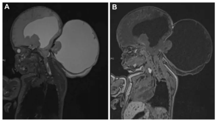 图2.出生后MRI。T2加权（A）和T1加权（B）矢状位扫描显示枕部脑膨出囊、加入的脑组织、后脑疝出及颈髓空洞症。注意与宫内MRI相比，脑积水有所加重。