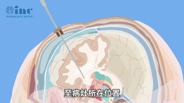 激光间质热疗（LITT）