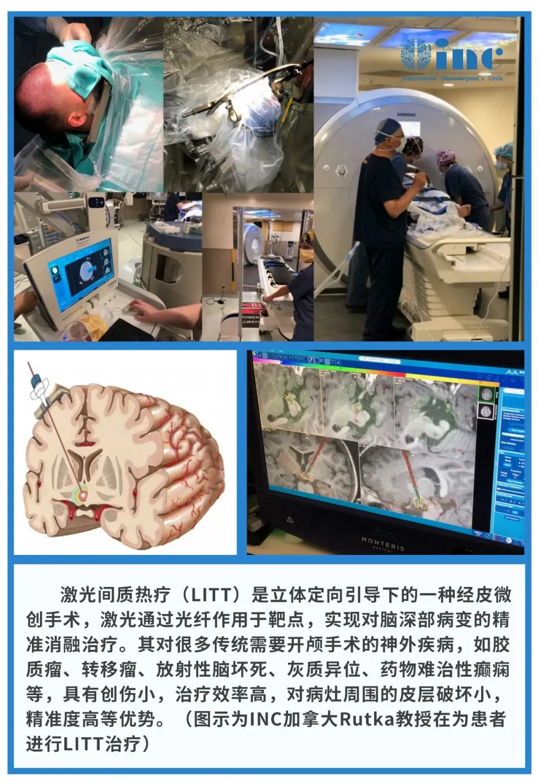 LITT优势