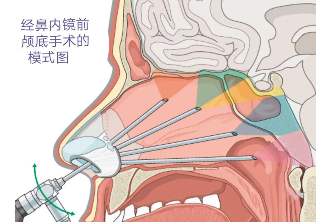 儿童经鼻内镜手术优势