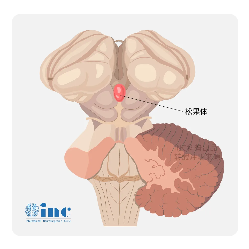 <a href='/bingzhong/sgtqzl/' target='_blank'><u>松果体区肿瘤</u></a>
