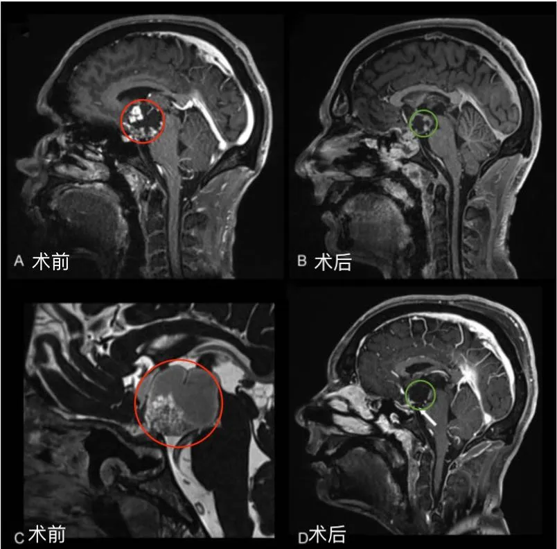图1后视交叉性巨大颅咽管瘤患者肿瘤术前（A，C）和术后（B,D）矢状位增强MR对比，显示肿瘤全切。